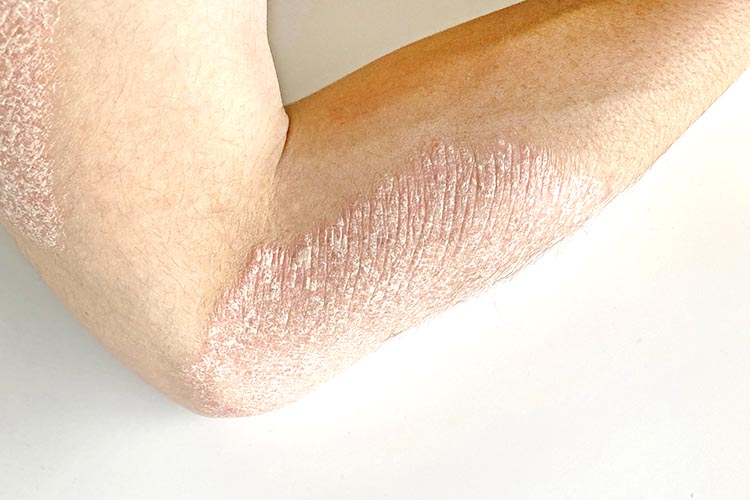 その他免疫の異常による疾患イメージ