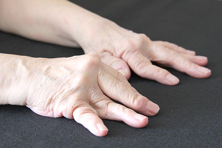 関節リウマチイメージ